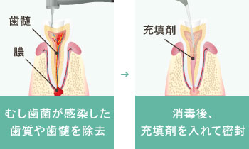 むし歯菌が感染した歯質や歯髄を除去 消毒後、充填剤を入れて密封