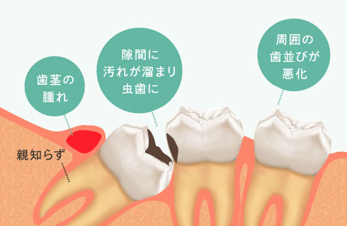 歯茎の腫れ、隙間に汚れが溜まり虫歯に、周囲の歯並びが悪化