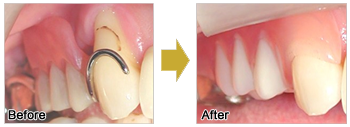 針金のある入れ歯・義歯から針金のない入れ歯・義歯のビフォーアフター