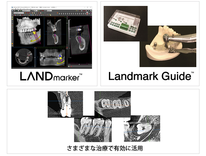 インプラント手術支援システム「Landmark System」