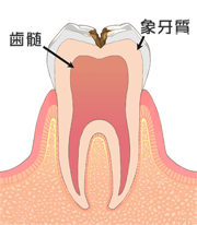Ｃ２：歯の中（象牙質）の虫歯